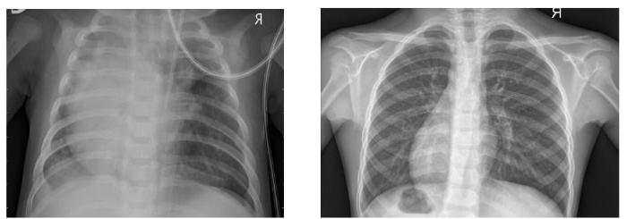 The image on the left shows a normal chest X-ray, whereas the one on the right shows lungs with pneumonia opacity.